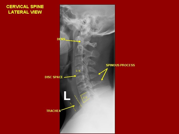 CERVICAL SPINE LATERAL VIEW DENS SPINOUS PROCESS C-4 DISC SPACE C-7 TRACHEA 