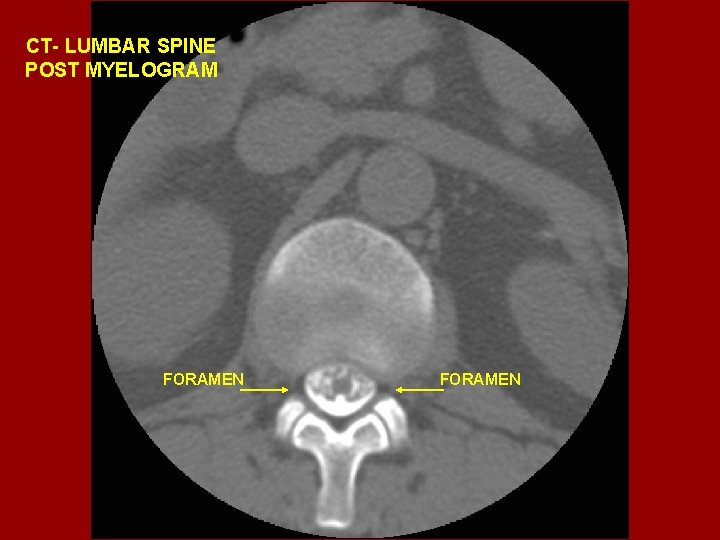 CT- LUMBAR SPINE POST MYELOGRAM FORAMEN 