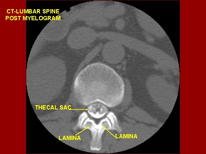 CT-LUMBAR SPINE POST MYELOGRAM THECAL SAC LAMINA 