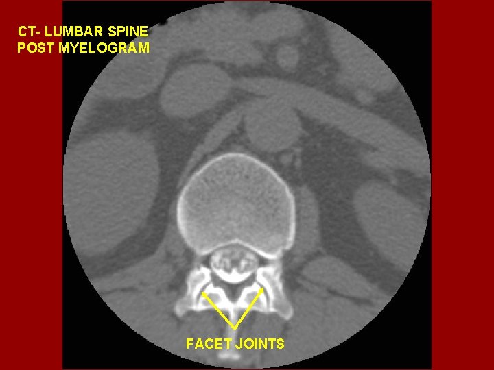 CT- LUMBAR SPINE POST MYELOGRAM FACET JOINTS 