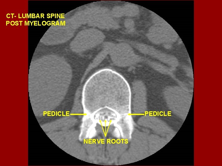 CT- LUMBAR SPINE POST MYELOGRAM PEDICLE NERVE ROOTS 