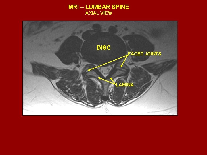 MRI – LUMBAR SPINE AXIAL VIEW DISC FACET JOINTS LAMINA 