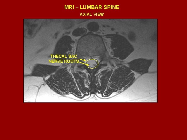 MRI – LUMBAR SPINE AXIAL VIEW THECAL SAC NERVE ROOTS 