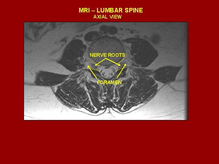 MRI – LUMBAR SPINE AXIAL VIEW NERVE ROOTS FORAMEN 