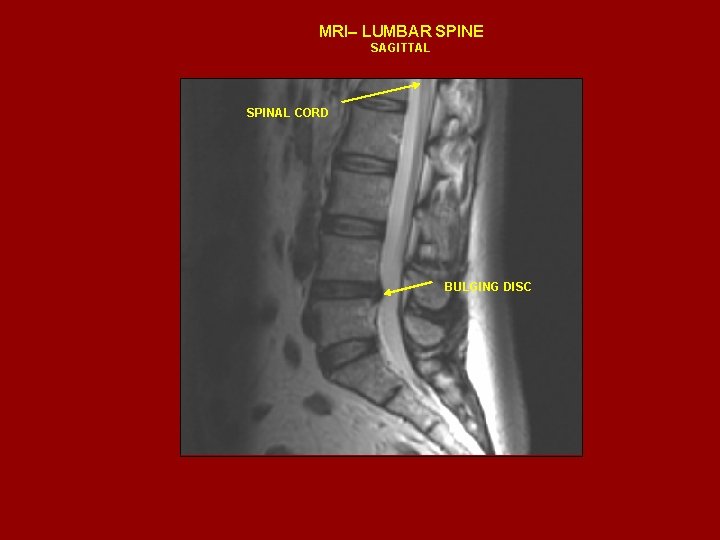 MRI– LUMBAR SPINE SAGITTAL SPINAL CORD BULGING DISC 