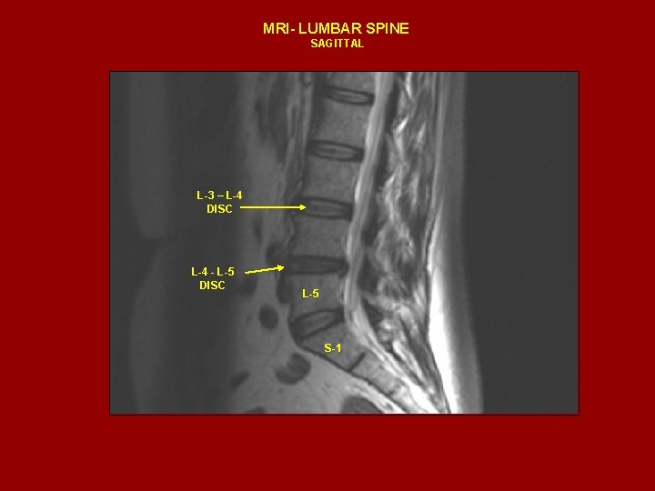 MRI- LUMBAR SPINE SAGITTAL L-3 – L-4 DISC L-4 - L-5 DISC L-5 S-1