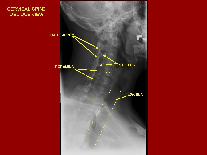 CERVICAL SPINE OBLIQUE VIEW FACET JOINTS PEDICLES FORAMINA C-5 TRACHEA T-1 