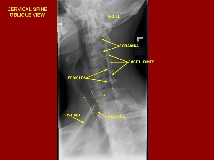 CERVICAL SPINE OBLIQUE VIEW SKULL FORAMINA FACET JOINTS PEDICLES C-7 FIRST RIB TRACHEA 