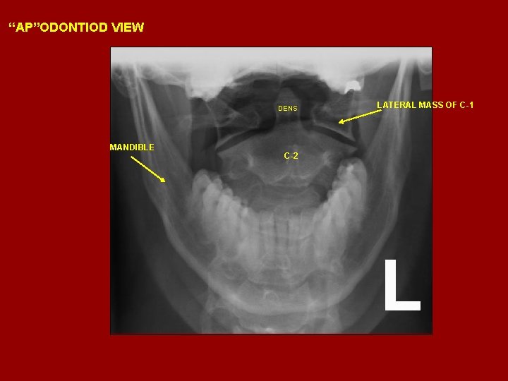 “AP”ODONTIOD VIEW DENS MANDIBLE C-2 LATERAL MASS OF C-1 