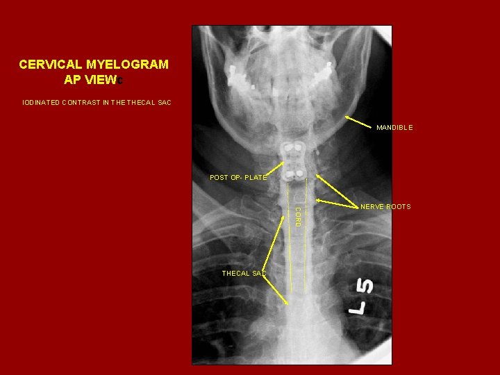CERVICAL MYELOGRAM AP VIEWc IODINATED CONTRAST IN THECAL SAC MANDIBLE POST OP- PLATE CORD