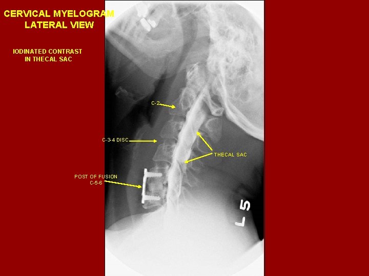 CERVICAL MYELOGRAM LATERAL VIEW IODINATED CONTRAST IN THECAL SAC C-2 C-3 -4 DISC THECAL