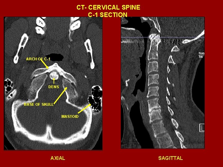 CT- CERVICAL SPINE C-1 SECTION ARCH OF C-1 DENS BASE OF SKULL MASTOID AXIAL