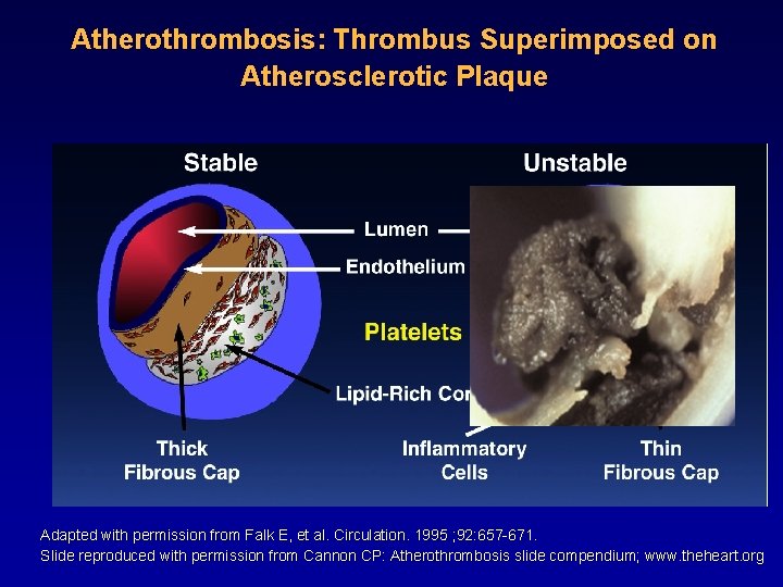 Atherothrombosis: Thrombus Superimposed on Atherosclerotic Plaque Adapted with permission from Falk E, et al.