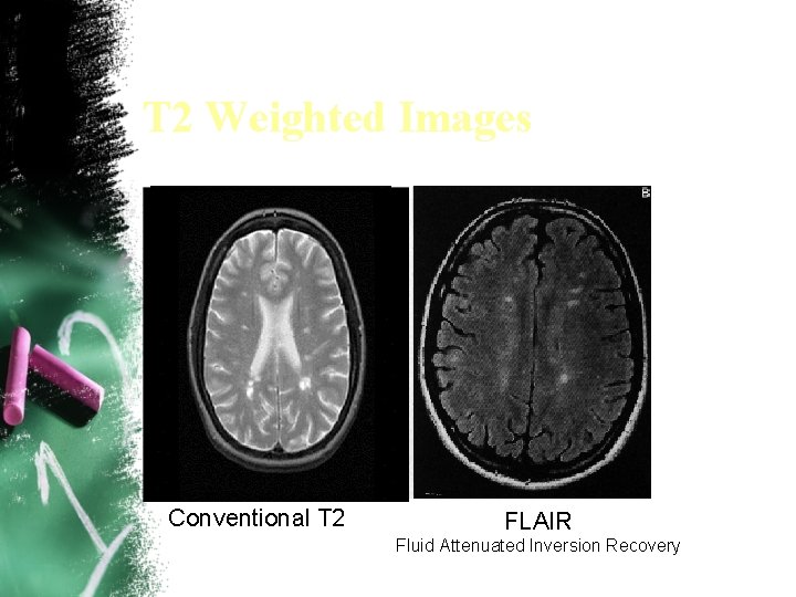 T 2 Weighted Images Conventional T 2 FLAIR Fluid Attenuated Inversion Recovery 