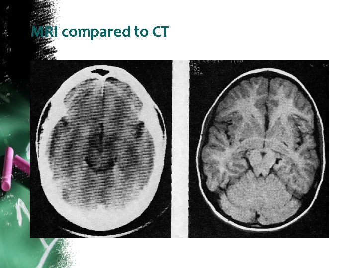 MRI compared to CT 