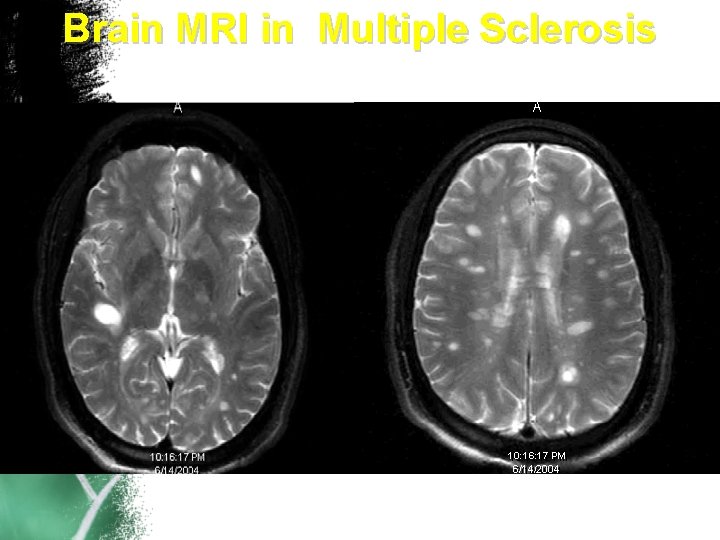 Brain MRI in Multiple Sclerosis 