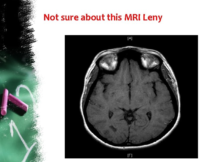 Not sure about this MRI Leny 