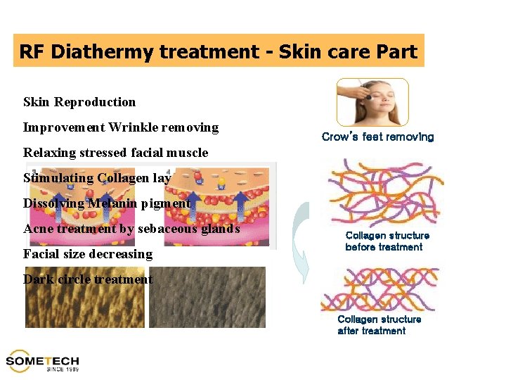 RF Diathermy treatment - Skin care Part Skin Reproduction Improvement Wrinkle removing Crow’s feet