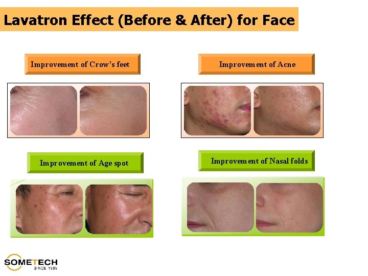 Lavatron Effect (Before & After) for Face Improvement of Crow’s feet Improvement of Age
