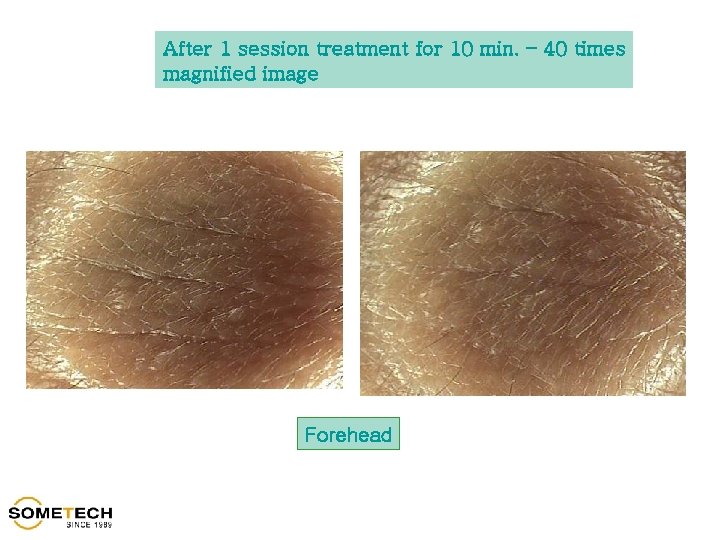 After 1 session treatment for 10 min. – 40 times magnified image Forehead 