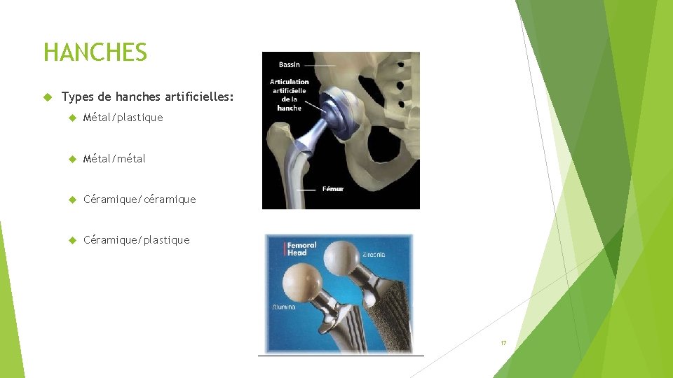 HANCHES Types de hanches artificielles: Métal/plastique Métal/métal Céramique/céramique Céramique/plastique 17 