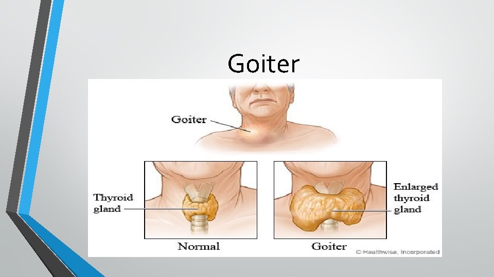 Goiter Goiter