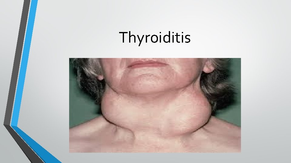 Thyroiditis 