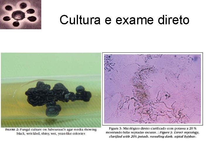 Cultura e exame direto Cultura e exame direto