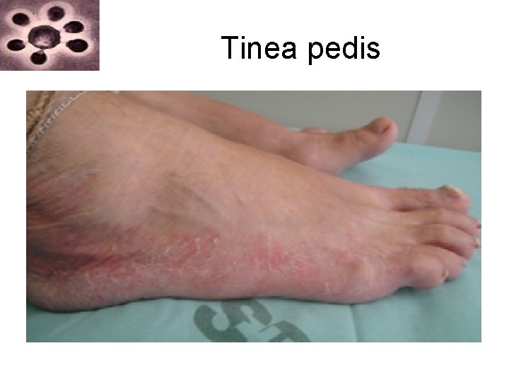 Tinea pedis Tinea pedis