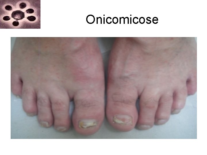 Onicomicose Onicomicose