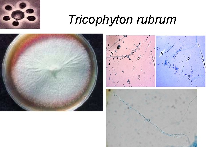 Tricophyton rubrum Tricophyton rubrum