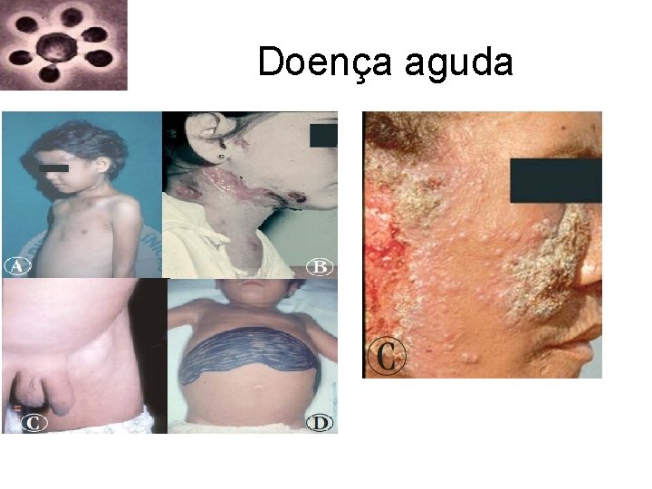 Doença aguda Doença aguda