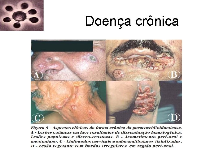 Doença crônica Doença crônica
