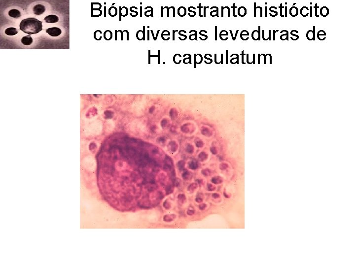 Biópsia mostranto histiócito com diversas leveduras de H. capsulatum Biópsia mostranto histiócito com diversas leveduras de H. capsulatum