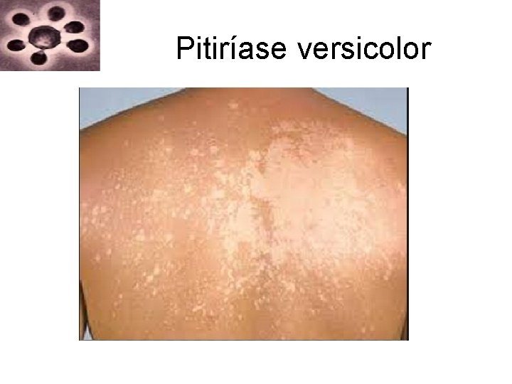 Pitiríase versicolor Pitiríase versicolor