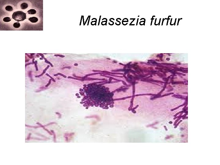 Malassezia furfur Malassezia furfur