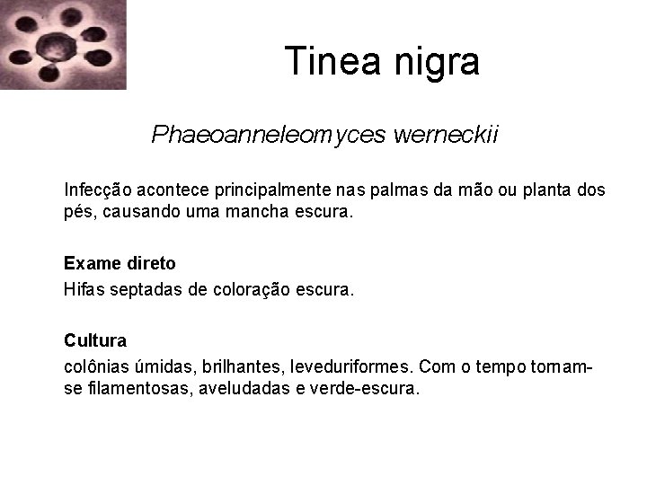 Tinea nigra Phaeoanneleomyces werneckii Infecção acontece principalmente nas palmas da mão ou planta dos Tinea nigra Phaeoanneleomyces werneckii Infecção acontece principalmente nas palmas da mão ou planta dos