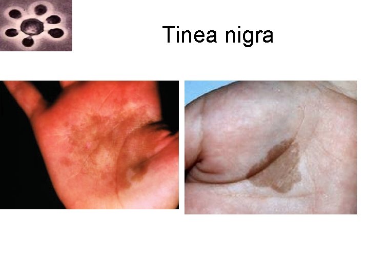 Tinea nigra Tinea nigra
