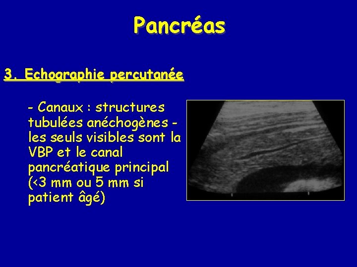 Pancréas 3. Echographie percutanée - Canaux : structures tubulées anéchogènes les seuls visibles sont