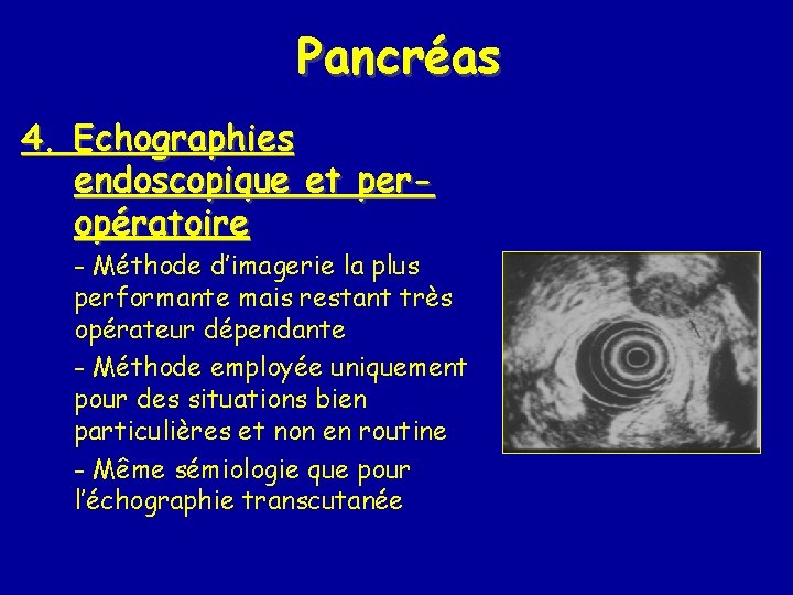 Pancréas 4. Echographies endoscopique et peropératoire - Méthode d’imagerie la plus performante mais restant