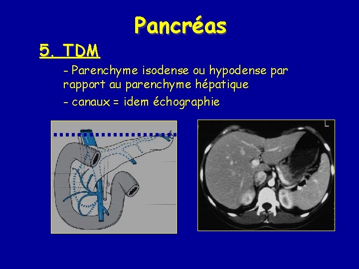 5. TDM Pancréas - Parenchyme isodense ou hypodense par rapport au parenchyme hépatique -