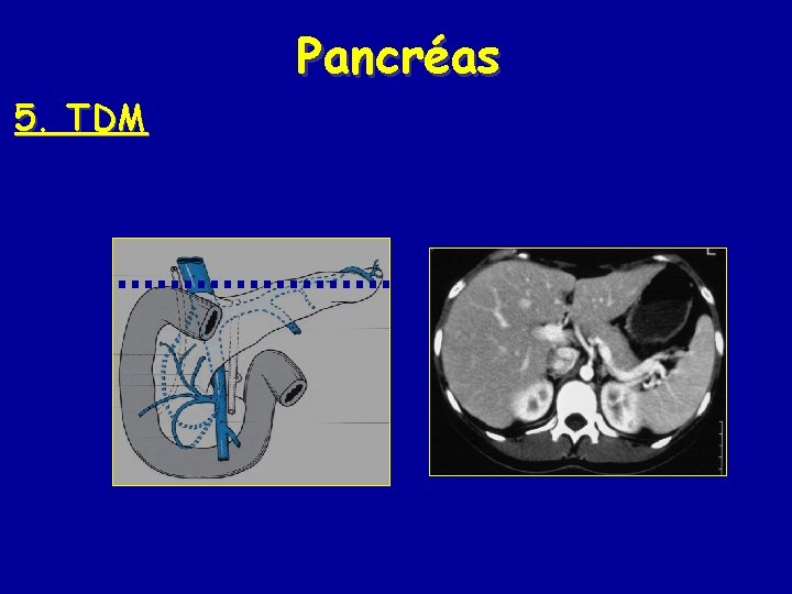 Pancréas 5. TDM Pancréas 5. TDM