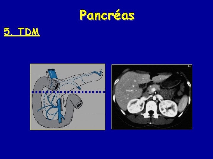 Pancréas 5. TDM 