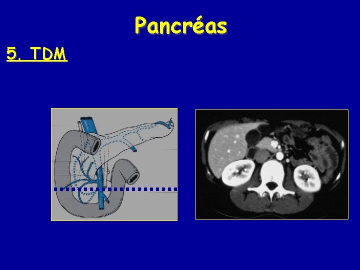 Pancréas 5. TDM 