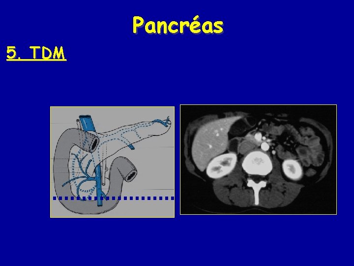 Pancréas 5. TDM 