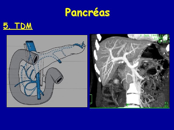 Pancréas 5. TDM 