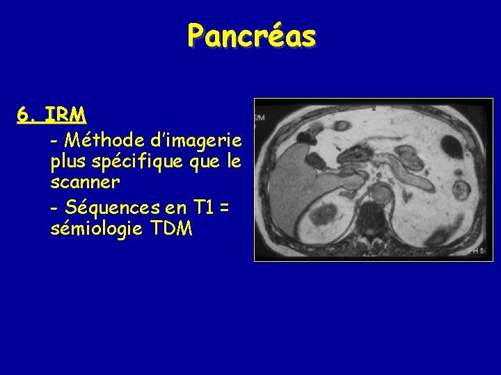 Pancréas 6. IRM - Méthode d’imagerie plus spécifique le scanner - Séquences en T