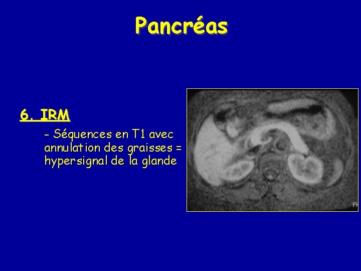 Pancréas 6. IRM - Séquences en T 1 avec annulation des graisses = hypersignal