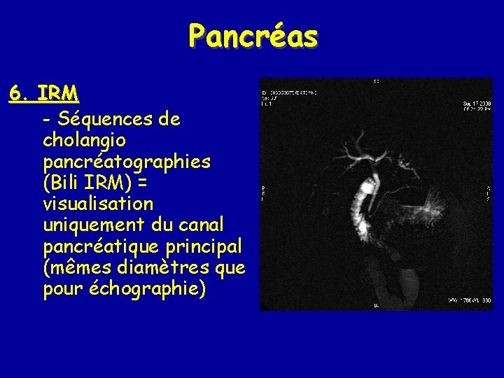 Pancréas 6. IRM - Séquences de cholangio pancréatographies (Bili IRM) = visualisation uniquement du