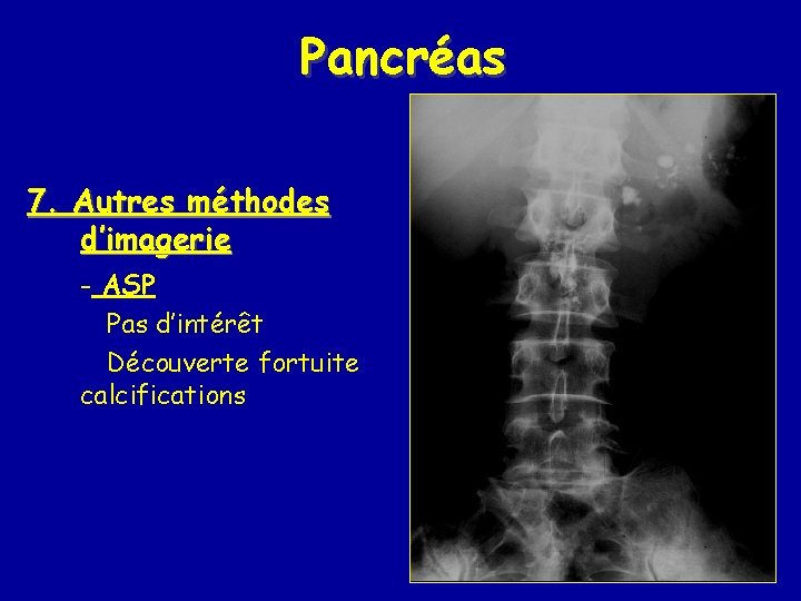 Pancréas 7. Autres méthodes d’imagerie - ASP Pas d’intérêt Découverte fortuite calcifications 